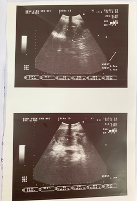 Hình ảnh siêu âm tử cung, phần phụ của bệnh nhân Nguyễn Thị Hoàng