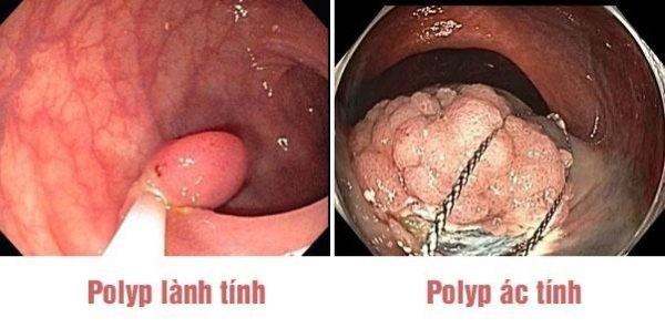 Khi nào cần tầm soát polyp đại tràng?