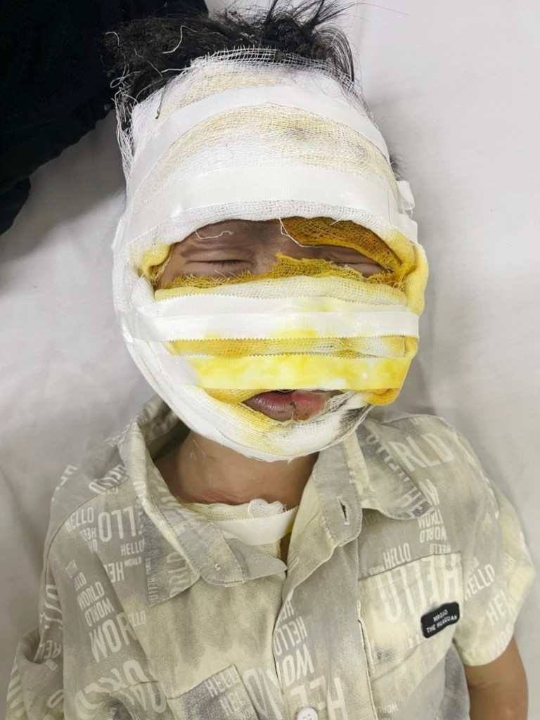 Bé trai 08 tuổi bị bỏng nặng vùng mặt khi sử dụng laptop phát nổ