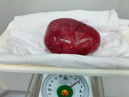 Phẫu thuật cắt bỏ u xơ tử cung nặng 2,2 kg tại Bệnh viện Sản Nhi Bắc Giang