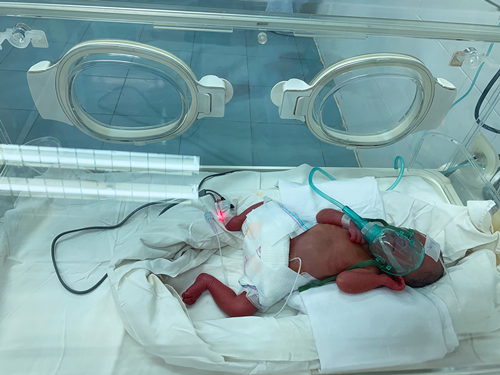 Hành trình nuôi dưỡng bé sinh non 26 tuần tuổi, nặng 700 gr tại Bệnh viện Sản Nhi Bắc Giang