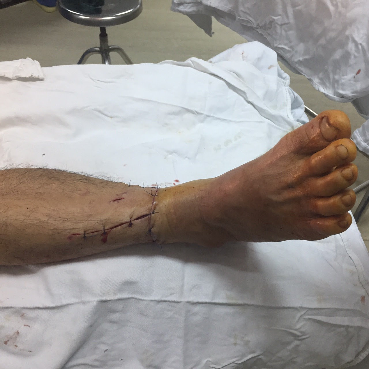 Bệnh viện Đa khoa tỉnh Bắc Giang cấp cứu nối lại cẳng chân cho bệnh nhân bị máy xén cỏ cắt đứt