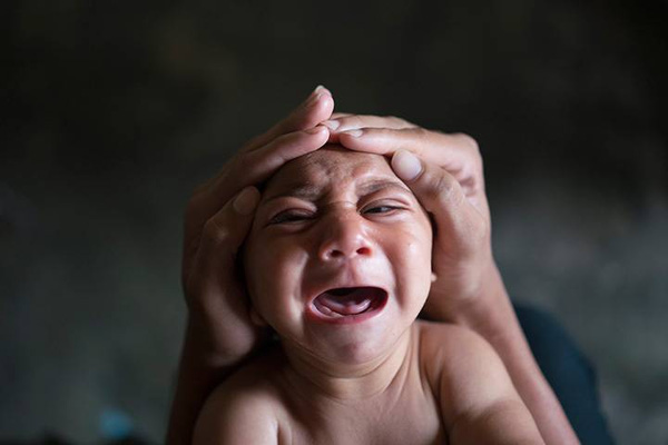 Phòng chống bệnh do vi rút Zika gây bệnh đầu nhỏ ở trẻ sơ sinh