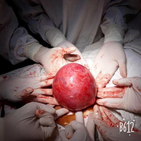 Bệnh viện Đa khoa huyện Lục Nam: Phẫu thuật thành công u xơ tử cung nặng 1,2 kg