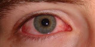 Bệnh đau mắt đỏ và những điều bạn cần biết